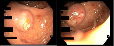 A rare case of solitary plasmacytoma mimicking submucosal lesion of ascending colon: a case report and literature review